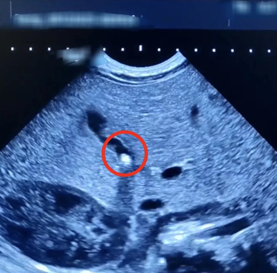 Саратовские врачи обнаружили у полуторамесячного младенца камень в желчном пузыре