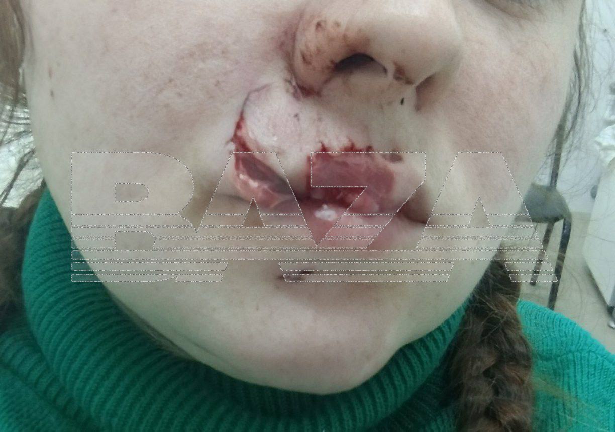 Собака откусила верхнюю губу 